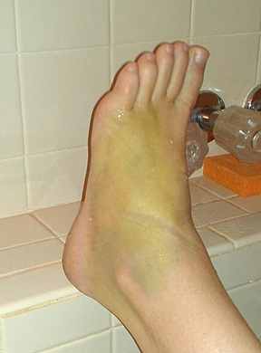 my broken green foot