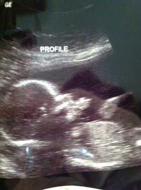 ultrasound sonogram